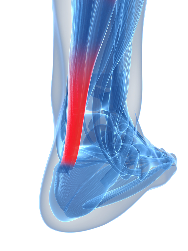 Achilles Tendinopathy patient